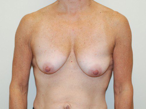 Breast Reconstruction Immediate Implant Before Patient 1