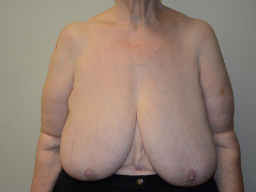 Breast Reduction Before Patient 1