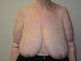 Breast Reduction Before Patient Thumbnail 1