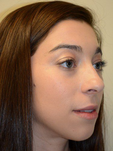Chin Augmentation Before Patient 2