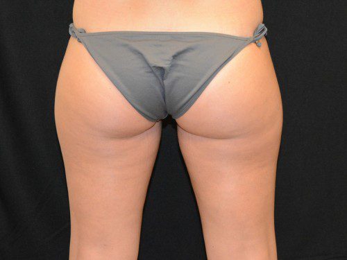 Coolsculpting Before Patient 2