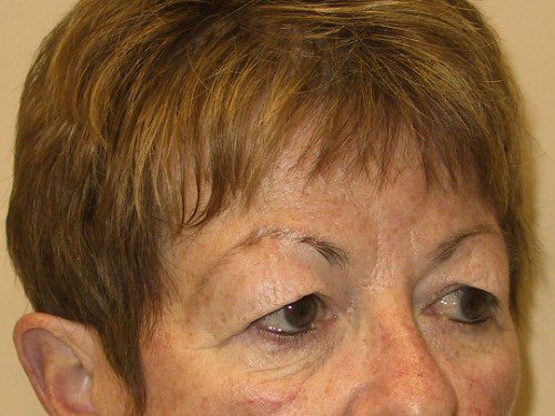 Eyelid Surgery Before Patient 2