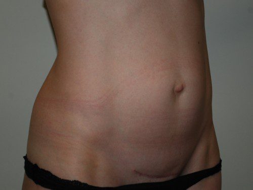 Mini Tummy Tuck Before Patient 2