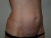 Mini Tummy Tuck Before Patient Thumbnail 2