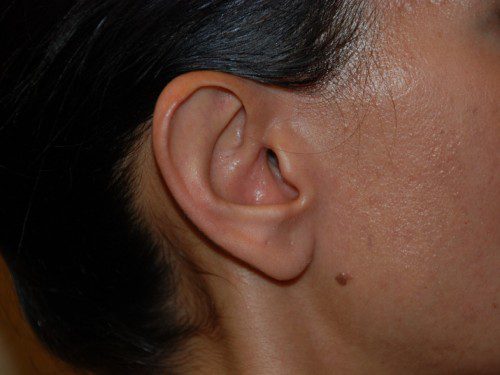 Prominent Ear Surgery Before Patient 2