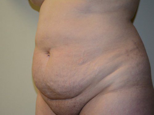 Tummy Tuck Before Patient 2