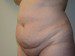 Tummy Tuck Before Patient Thumbnail 2