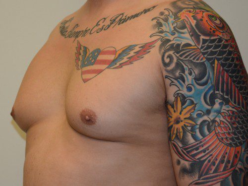 Male Breast Reduction Before Patient 2