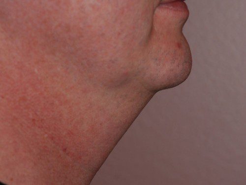 Neck Liposuction Before Patient 4