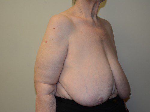 Breast Reduction Before Patient 2