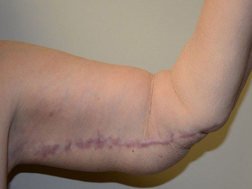 Arm Lift After Patient 3
