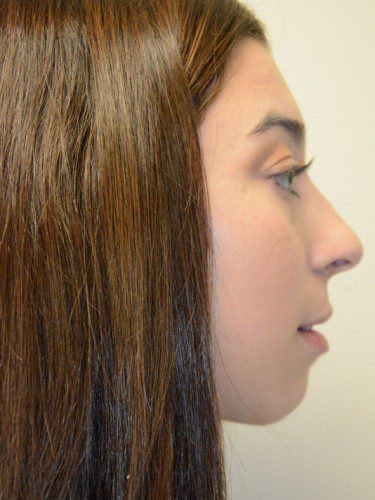 Chin Augmentation Before Patient 4