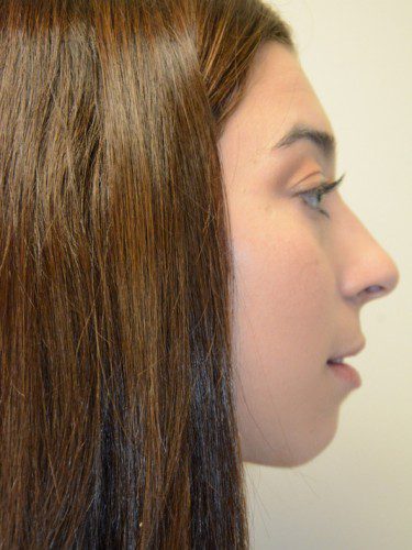 Chin Augmentation Before Patient 4