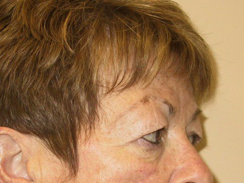 Eyelid Surgery Before Patient 4