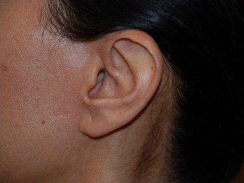 Prominent Ear Surgery Before Patient 3