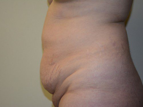 Tummy Tuck Before Patient 4