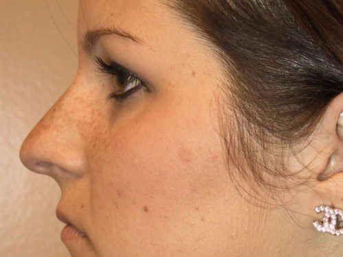 Rhinoplasty Before Patient 3