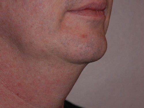 Neck Liposuction Before Patient 2