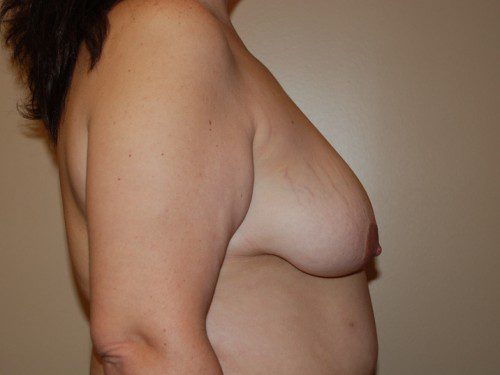 Breast Lift Before Patient 4
