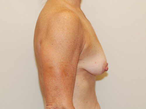 Breast Reconstruction Immediate Implant Before Patient 4