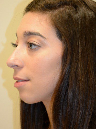 Chin Augmentation Before Patient 3