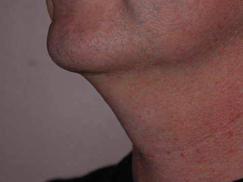 Neck Liposuction Before Patient 3