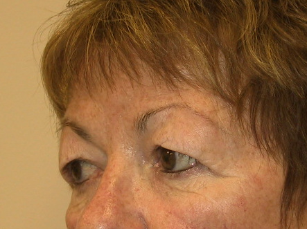 Eyelid Surgery Before Patient 3