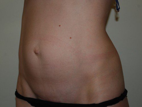 Mini Tummy Tuck Before Patient 3