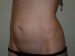 Mini Tummy Tuck Before Patient Thumbnail 3