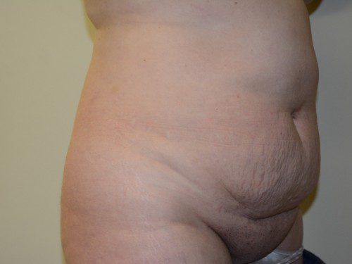 Tummy Tuck Before Patient 3