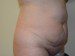 Tummy Tuck Before Patient Thumbnail 3