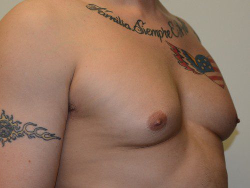 Male Breast Reduction Before Patient 3