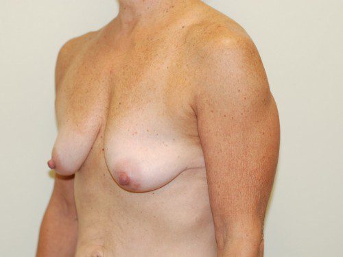Breast Reconstruction Immediate Implant Before Patient 3