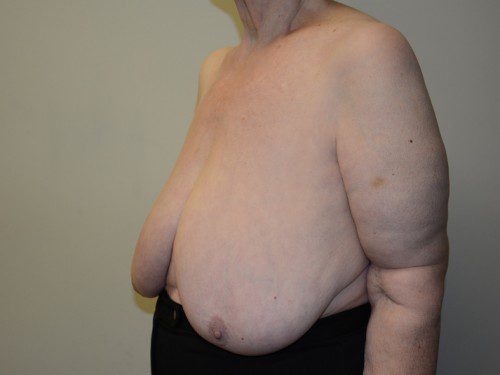 Breast Reduction Before Patient 3