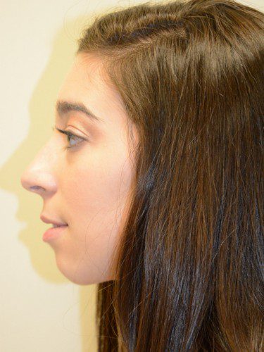 Chin Augmentation Before Patient 5