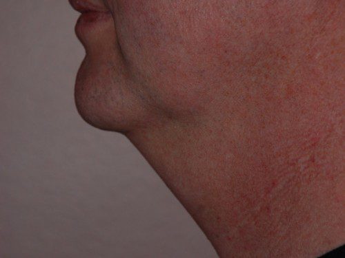 Neck Liposuction Before Patient 5