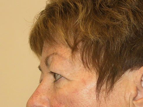 Eyelid Surgery Before Patient 5