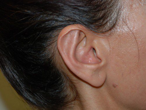 Prominent Ear Surgery After Patient 2
