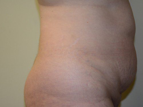 Tummy Tuck Before Patient 5