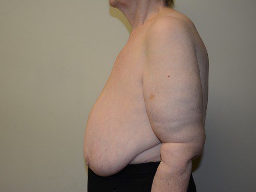 Breast Reduction Before Patient 5