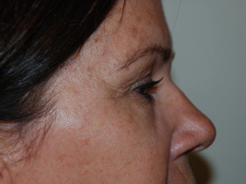 Brow Lift Before Patient 5