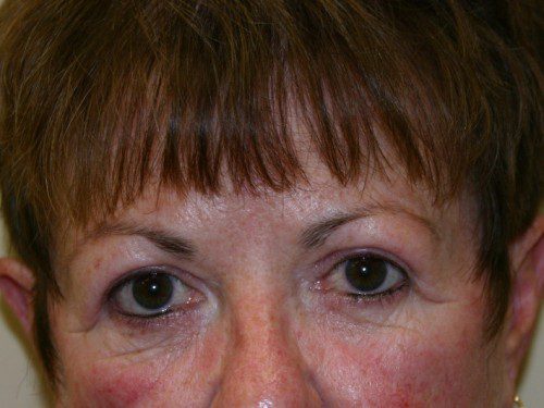 Eyelid Surgery After Patient 1