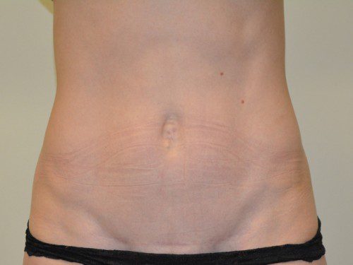 Mini Tummy Tuck After Patient 1