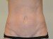 Mini Tummy Tuck After Patient Thumbnail 1