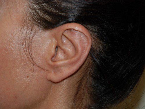 Prominent Ear Surgery After Patient 3