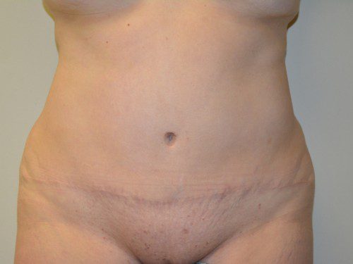 Tummy Tuck After Patient 1