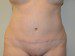 Tummy Tuck After Patient Thumbnail 1