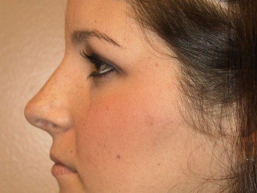 Rhinoplasty After Patient 3