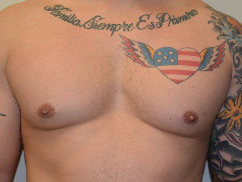 Male Breast Reduction After Patient 1