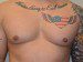 Male Breast Reduction After Patient Thumbnail 1